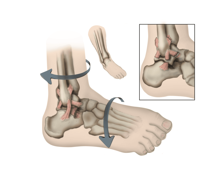 foot_sprained-ankle-a00150_bodyalmanac2003_kh